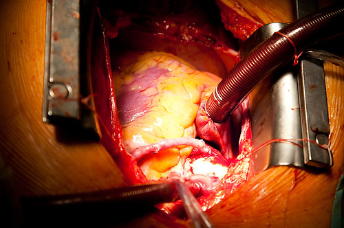 coronary artery bypass grafting on open heart