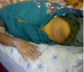 Kulsumbibi aged 50 years bitten by police in her home at 2.15am who did not complaint up to 3 days due to fear and did go to even hospital for 3 days.