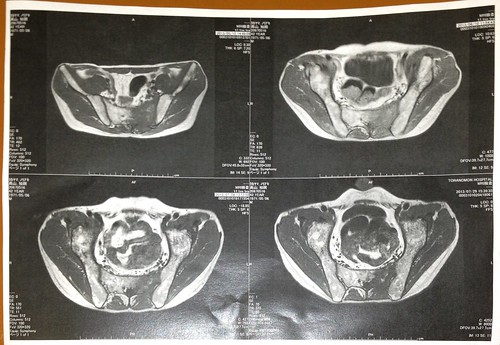 入院中の腰のMRI画像。腫瘍が縮小。2013.7.31