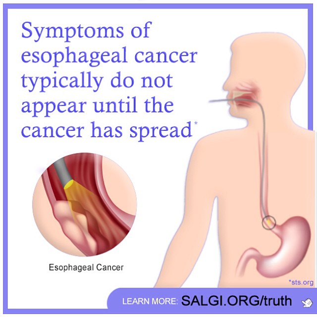 esophageal cancer causes